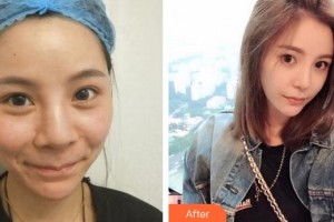 廈門市第一醫(yī)院思明分院整形外科許春鵬整形價格表附鼻部多項 日式自然鼻案例展示