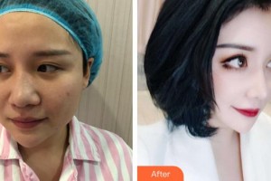 陳春水整形價格表附隆鼻修復+精微眼部手術案例展示