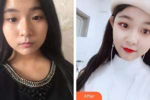 王根治整形價格表附爽妹子爽的鼻部手術案例展示