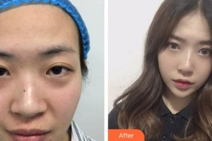 廈門莫琳娜醫(yī)療美容門診部黃星諺整形價格表附超激光美膚細膩膚質(zhì)案例展示