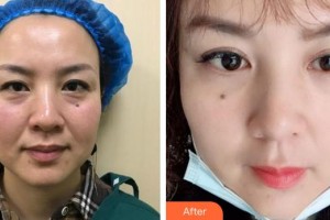 廈門莫琳娜醫(yī)療美容門診部吳曉紅整形價格表附不開刀祛眼袋+淚溝填充案例展示