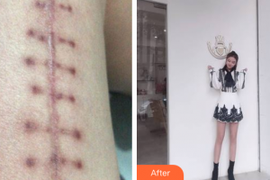 廣州尚美善造美容醫(yī)院邵方整形價(jià)格表附微創(chuàng)疤痕修復(fù)案例展示