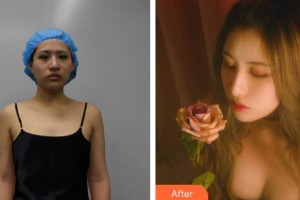 廈門莫琳娜醫(yī)療美容門診部李公昌整形價格表附胸部案例展示