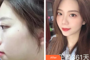 廣州醫(yī)學(xué)院口腔醫(yī)院張清彬整形價(jià)格表附骨性齙牙矯正案例展示