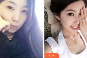 廣州醫(yī)學(xué)院口腔醫(yī)院李商輝整形價(jià)格表附牙齒隱形矯正案例展示