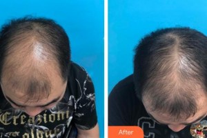 廈門銀河整形美容醫(yī)院呂巧云整形價(jià)格表附脫發(fā)調(diào)節(jié)重在堅(jiān)持案例展示