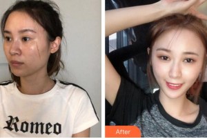 廈門新開元醫(yī)院整形美容中心姜善潤整形價(jià)格表附凹陷疤痕案例展示