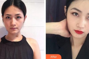 廈門新開元醫(yī)院整形美容中心李城杓整形價(jià)格表附增生疤痕案例展示