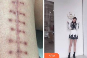 廈門新開元醫(yī)院整形美容中心簡銘成整形價(jià)格表附微創(chuàng)疤痕修復(fù)案例展示