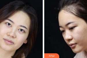 廈門海峽整形美容醫(yī)院曾美玲整形價(jià)格表附眼部整形案例展示