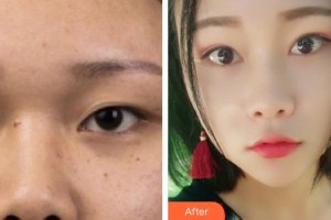 廈門海峽整形美容醫(yī)院劉歆整形價(jià)格表附眼部手術(shù)案例展示