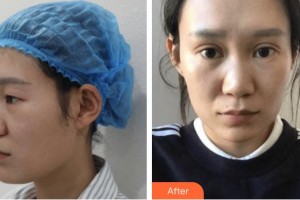 廈門大學(xué)附屬中山醫(yī)院整形美容科洪素莊整形價(jià)格表附雙眼皮案例展示