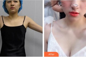 廈門大學(xué)附屬中山醫(yī)院整形美容科李鋒整形價(jià)格表附自體脂肪隆胸案例展示