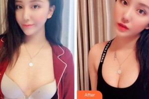 廈門福華醫(yī)療美容診所王建華整形價(jià)格表附濃縮豐胸真實(shí)案例展示