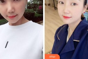 廈門修志夫整形美容醫(yī)院馮建苓整形價(jià)格表附肋軟骨隆鼻案例展示