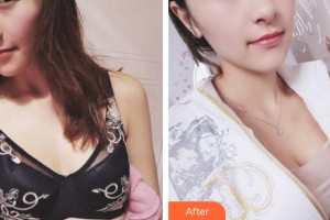 廈門天濟(jì)醫(yī)院醫(yī)療美容科朱文煌整形價(jià)格表附濃縮豐胸真實(shí)案例展示
