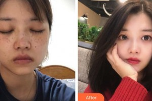 廈門張銘整醫(yī)療美容診所張小玲整形價(jià)格表附激光美膚案例展示