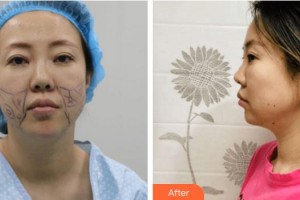 廈門黃巖整形美容醫(yī)院張皓林整形價(jià)格表附埋線提升案例展示