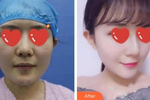 廈門美萊醫(yī)療美容醫(yī)院王忠堂整形價(jià)格表附	自體脂肪填充多方面部案例展示