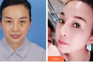 廈門華美名媛整形美容醫(yī)院陳運(yùn)生整形價(jià)格表附埋線提升案例展示