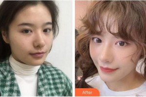 廈門美萊醫(yī)療美容醫(yī)院劉乃仁整形價(jià)格表附“熱瑪吉”多方面部 緊致提升案例展示