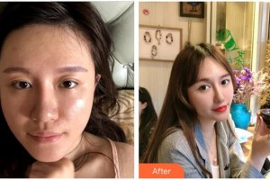 姚瑤整形價(jià)格表附“埋線提升”進(jìn)口P丙二醇可吸案例展示