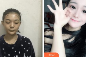 廈門華美名媛整形美容醫(yī)院陳燕喜整形價(jià)格表附種植發(fā)際線案例展示