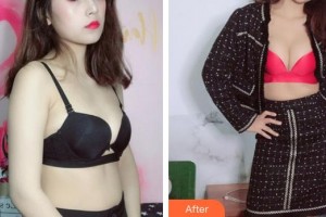 廈門薇格整形外科門診部崔元碩整形價(jià)格表附濃縮豐胸真實(shí)案例展示