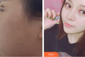 廈門薇格整形外科門診部俞翰秀整形價(jià)格表附雙眼皮案例展示