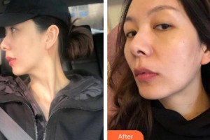 廈門安黛美整形外科門診部邱健欽整形價(jià)格表附熱瑪吉案例展示