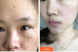 廈門臉博士整形醫(yī)院林達敏整形價格表附超激光美膚祛斑案例展示