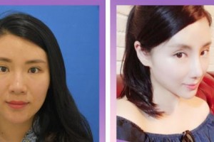 廈門美麗薇整形美容醫(yī)院吳原碩整形價格表附經典美鼻部手術 多方位美鼻案例展示