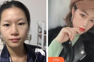 廈門美麗薇整形美容醫(yī)院李周憲整形價格表附埋線提升提升案例展示