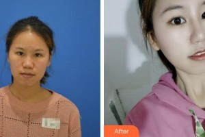 廈門美麗薇整形美容醫(yī)院樸晟皖整形價格表附鼻部手術案例展示