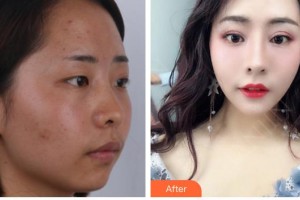 廈門美麗薇整形美容醫(yī)院金龍現整形價格表附耳軟骨隆鼻案例展示