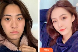 廈門蔡懿醫(yī)療美容診所謝樹榮整形價(jià)格表附埋線提升提升案例展示