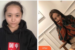 廈門重森植發(fā)整形外科門診部張斌奕整形價(jià)格表附發(fā)際線后移 女性發(fā)際線種植案例展示