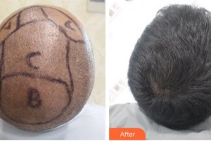 廈門雍禾植發(fā)醫(yī)療美容門診部王斌整形價(jià)格表附頭發(fā)種植案例展示