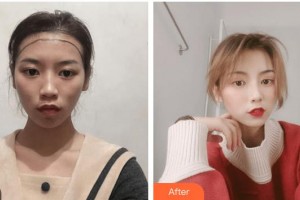 廈門雍禾植發(fā)醫(yī)療美容門診部鄧本文整形價(jià)格表附發(fā)際線高 發(fā)際線調(diào)整案例展示