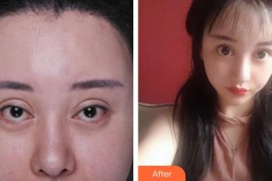 廈門大學(xué)附屬?gòu)B門眼科中心醫(yī)院蔡錦紅整形價(jià)格表附失敗重瞼修復(fù)+上瞼下垂矯正案例展示