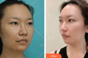 廈門大學(xué)附屬?gòu)B門眼科中心醫(yī)院盧奕整形價(jià)格表附雙眼皮案例展示