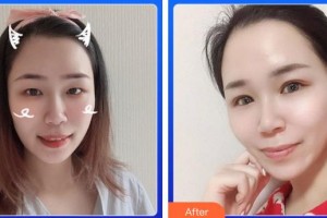 廈門大學(xué)附屬?gòu)B門眼科中心醫(yī)院劉旭陽整形價(jià)格表附5S重瞼術(shù)+超微創(chuàng)開內(nèi)眥案例展示