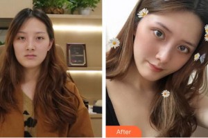 廈門大學(xué)附屬?gòu)B門眼科中心醫(yī)院王玉宏整形價(jià)格表附切開雙眼皮案例展示