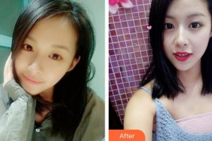 廈門大學(xué)附屬?gòu)B門眼科中心醫(yī)院陳偉整形價(jià)格表附精致雙眼皮案例展示