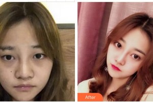 廈門大學(xué)附屬?gòu)B門眼科中心醫(yī)院吳仁毅整形價(jià)格表附眼部手術(shù)案例展示