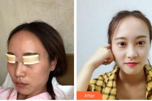 廈門大學(xué)附屬?gòu)B門眼科中心醫(yī)院劉志雄整形價(jià)格表附眼部手術(shù)案例展示