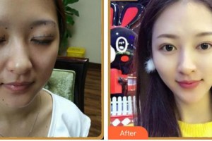 廈門大學(xué)附屬?gòu)B門眼科中心醫(yī)院張淳整形價(jià)格表附眼部多項(xiàng)案例展示