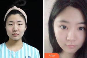 廈門大學(xué)附屬?gòu)B門眼科中心醫(yī)院崔麗飛整形價(jià)格表附眼部案例展示