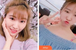 廈門大學(xué)附屬?gòu)B門眼科中心醫(yī)院李煒整形價(jià)格表附切開雙眼皮案例展示