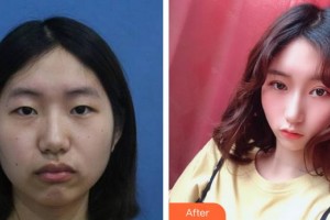 廈門大學(xué)附屬?gòu)B門眼科中心醫(yī)院李立梅整形價(jià)格表附上瞼微整案例展示